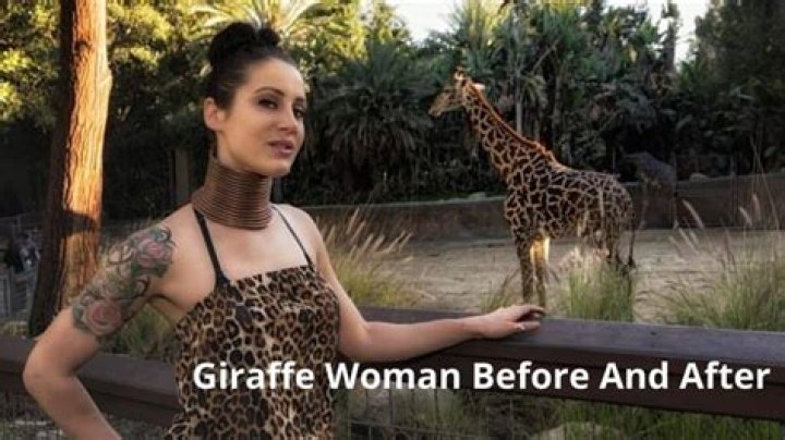Giraffe Woman Before & After Neck Ring Removed (Photos)