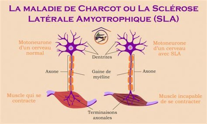 Leonard Maladie De Charcot