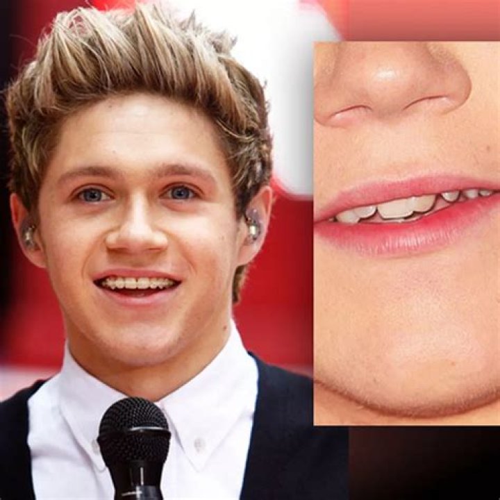One Direction’s Niall Horan Takes Off Braces: Reveals Smile Makeover