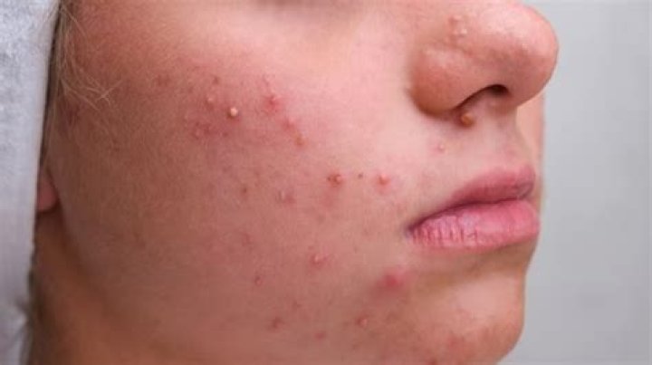 Sperm Can Clear Pimples And Acne – Efia Odo Reportedly Claims